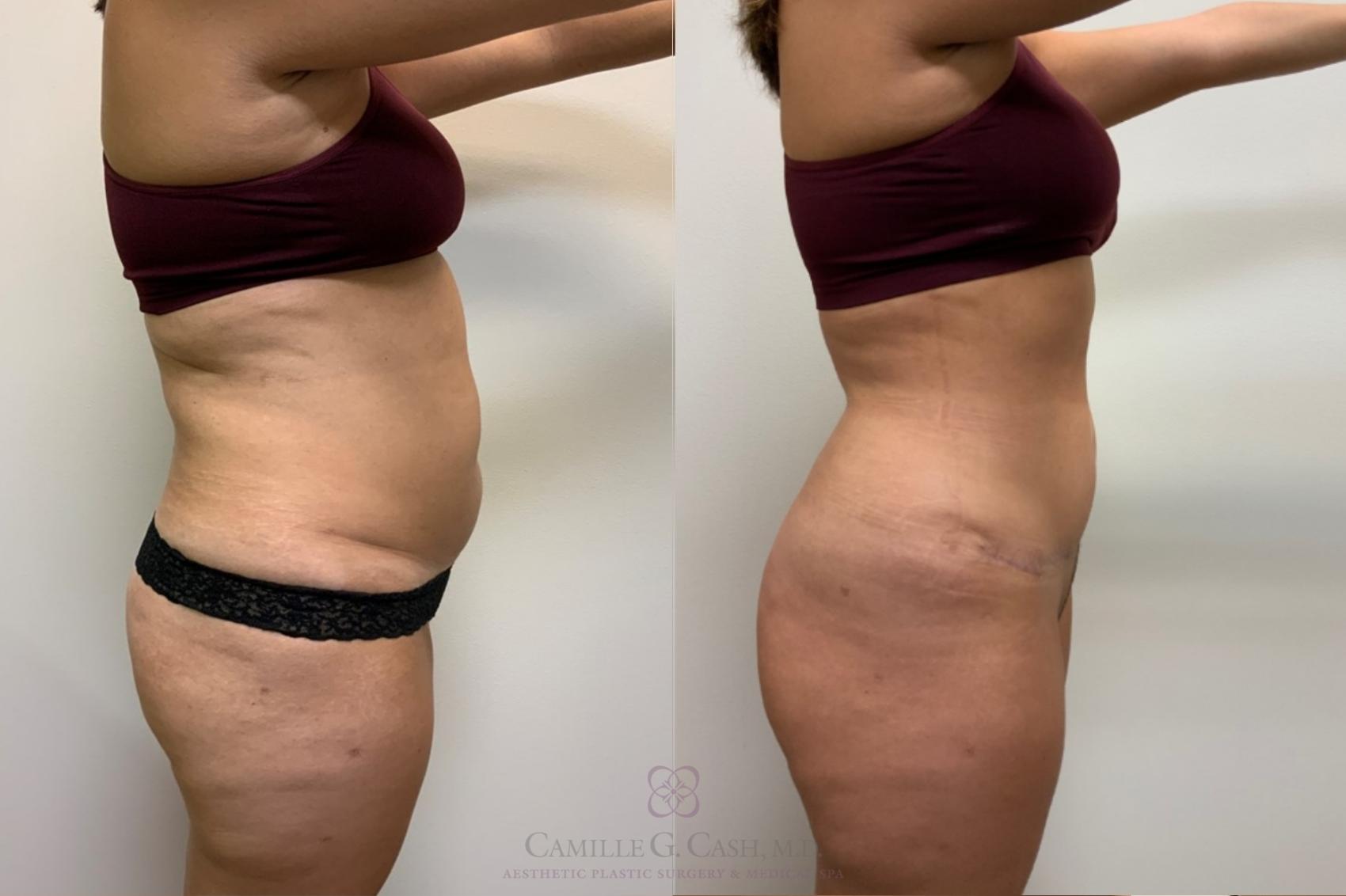 Before & After Tummy Tuck Case 487 Left Side View in Houston, TX