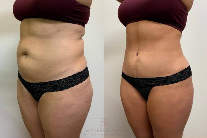 Before & After Tummy Tuck Case 487 Right Oblique View in Houston, TX