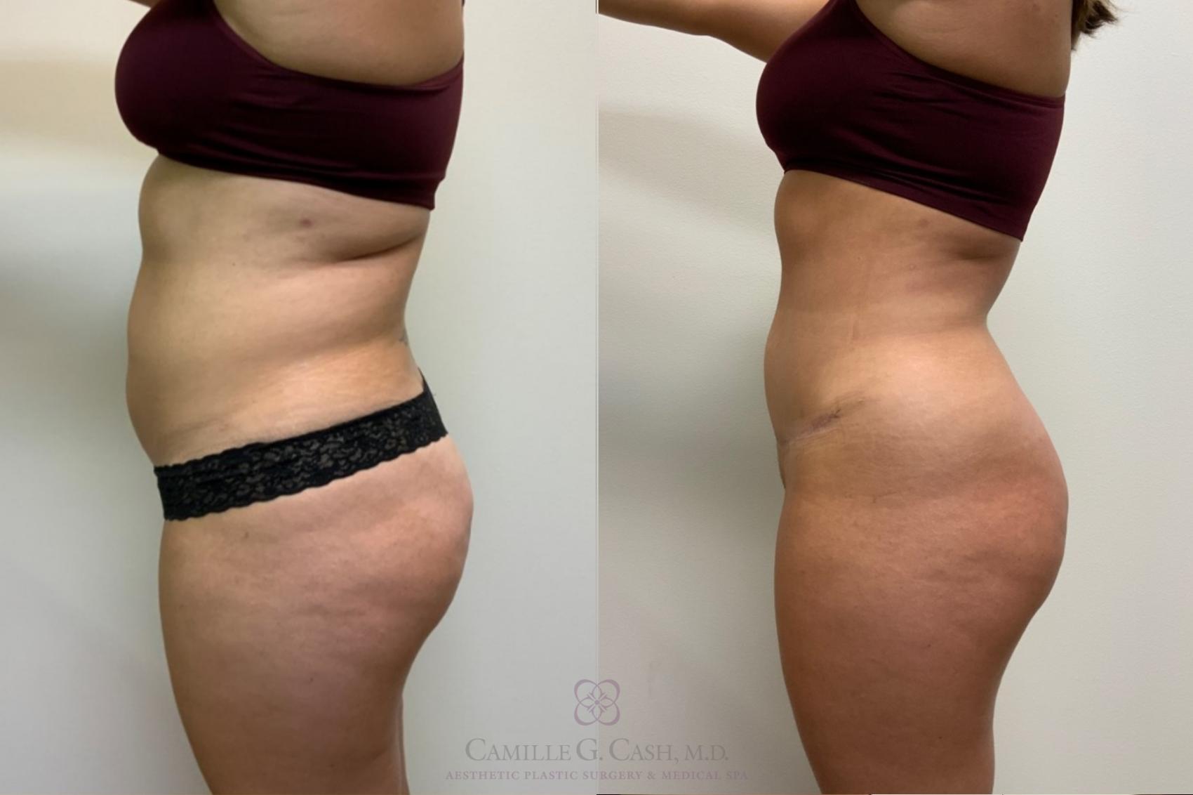 Before & After Tummy Tuck Case 487 Right Side View in Houston, TX