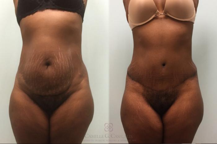 Before & After Tummy Tuck Case 492 Front View in Houston, TX