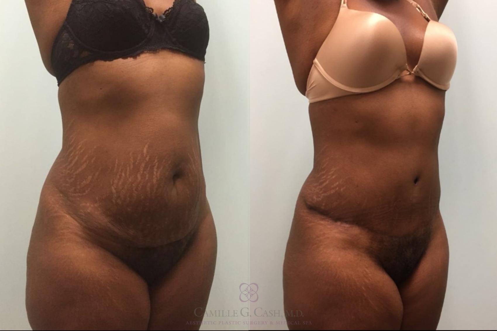 Before & After Tummy Tuck Case 492 Left Oblique View in Houston, TX