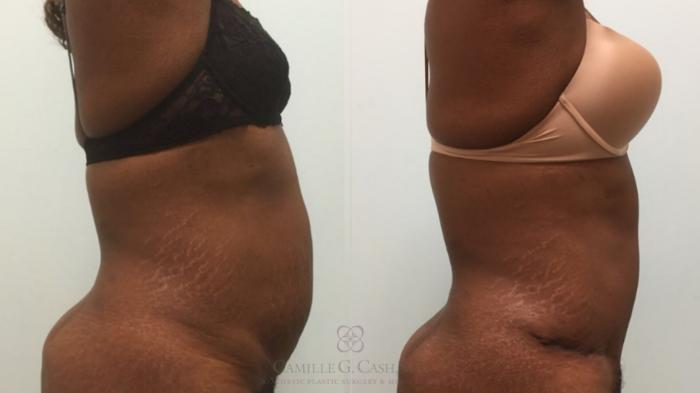 Before & After Tummy Tuck Case 492 Left Side View in Houston, TX