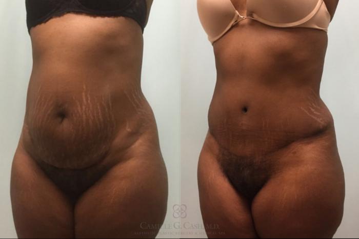 Before & After Tummy Tuck Case 492 Right Oblique View in Houston, TX