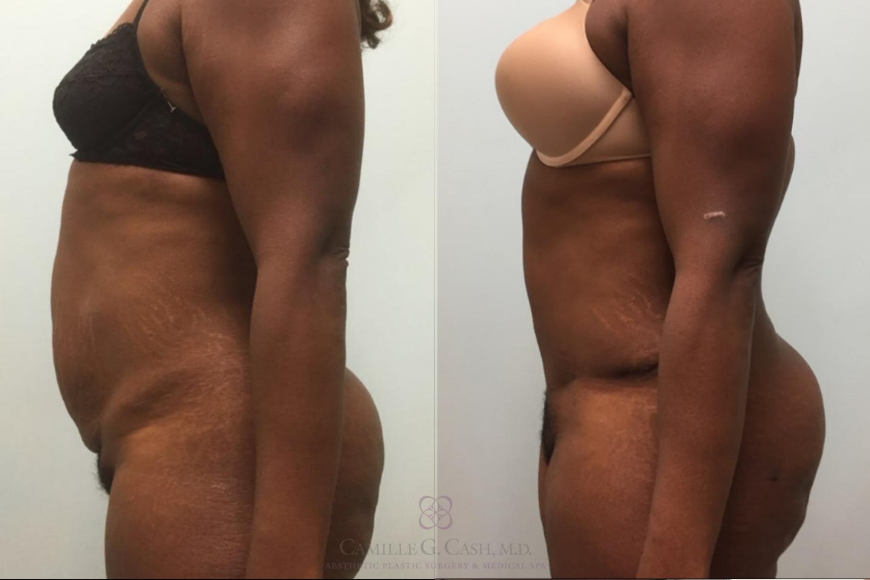 Before & After Tummy Tuck Case 492 Right Side View in Houston, TX