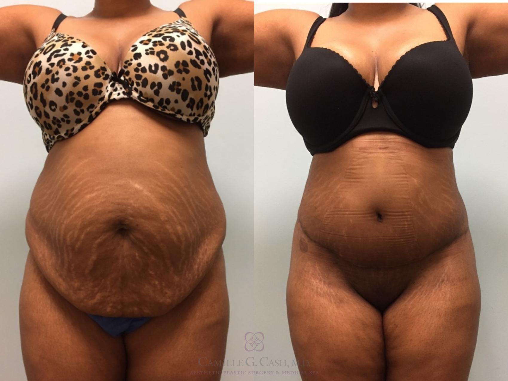 Before & After Tummy Tuck Case 512 Front View in Houston, TX