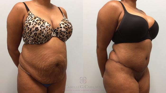 Before & After Tummy Tuck Case 512 Left Oblique View in Houston, TX