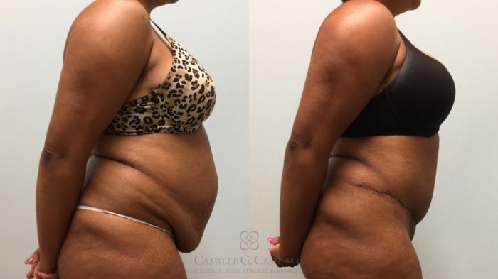 Before & After Tummy Tuck Case 512 Left Side View in Houston, TX