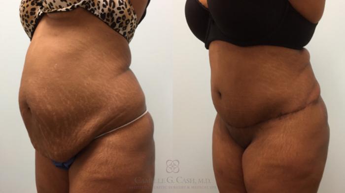 Before & After Tummy Tuck Case 512 Right Oblique View in Houston, TX