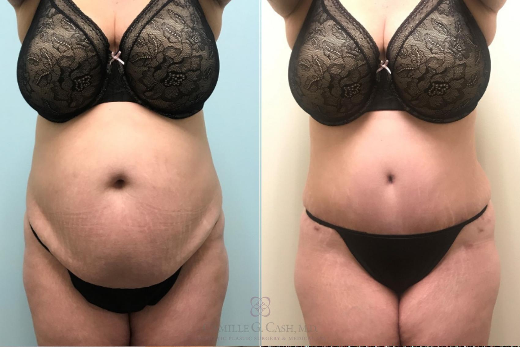 Before & After Tummy Tuck Case 515 Front View in Houston, TX