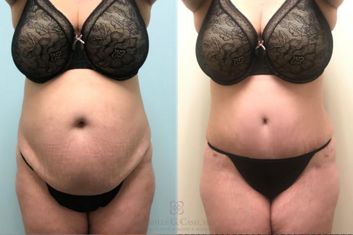 Before & After Tummy Tuck Case 515 Front View in Houston, TX