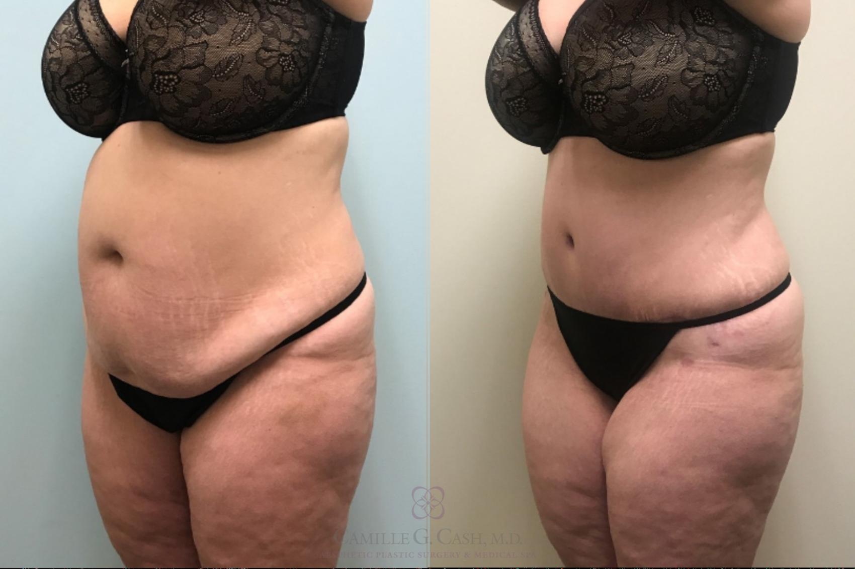 Before & After Tummy Tuck Case 515 Left Oblique View in Houston, TX