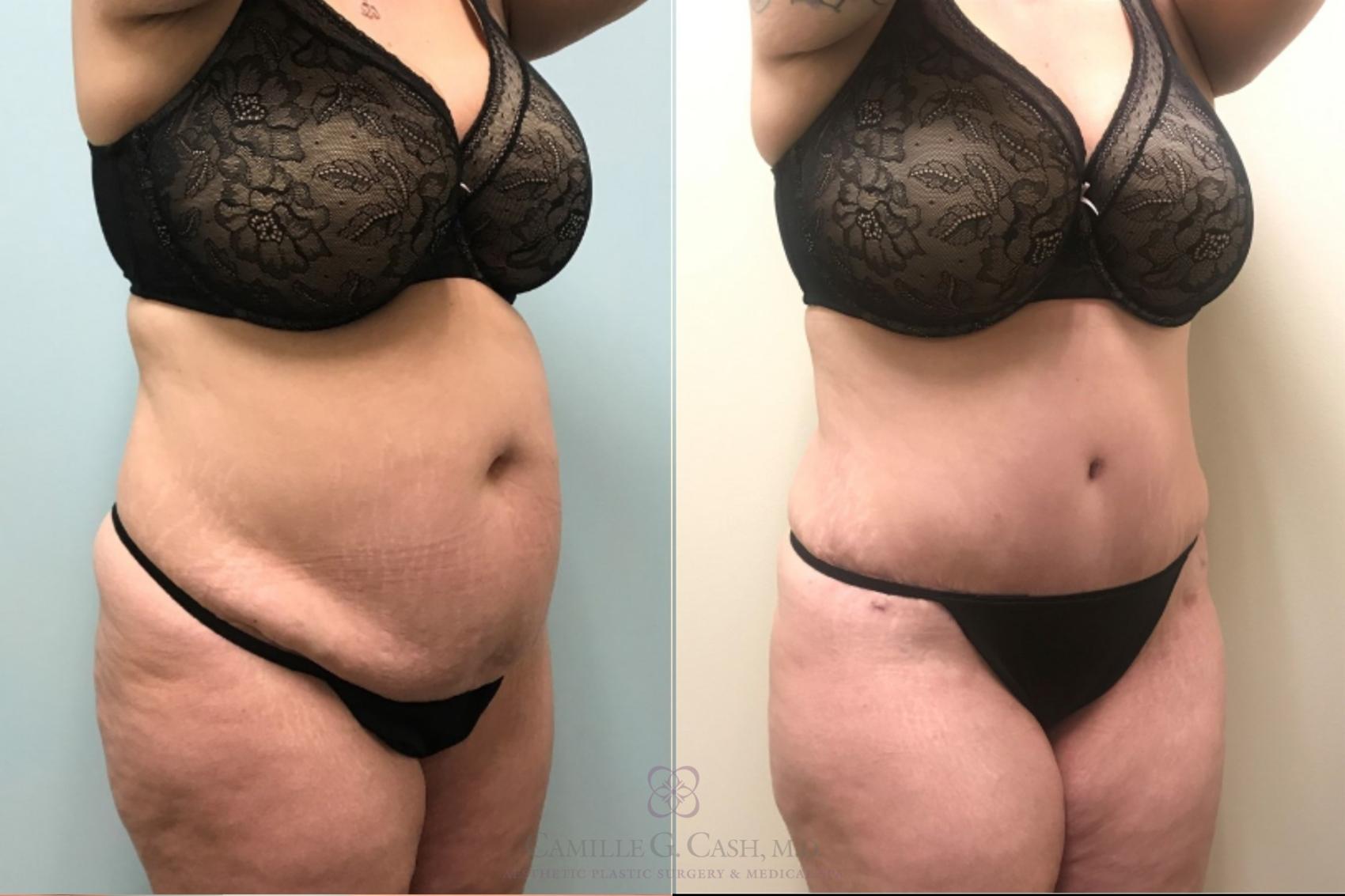 Before & After Tummy Tuck Case 515 Right Oblique View in Houston, TX