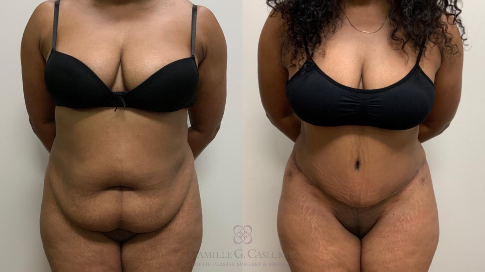 Before & After Liposuction Case 518 Front View in Houston, TX