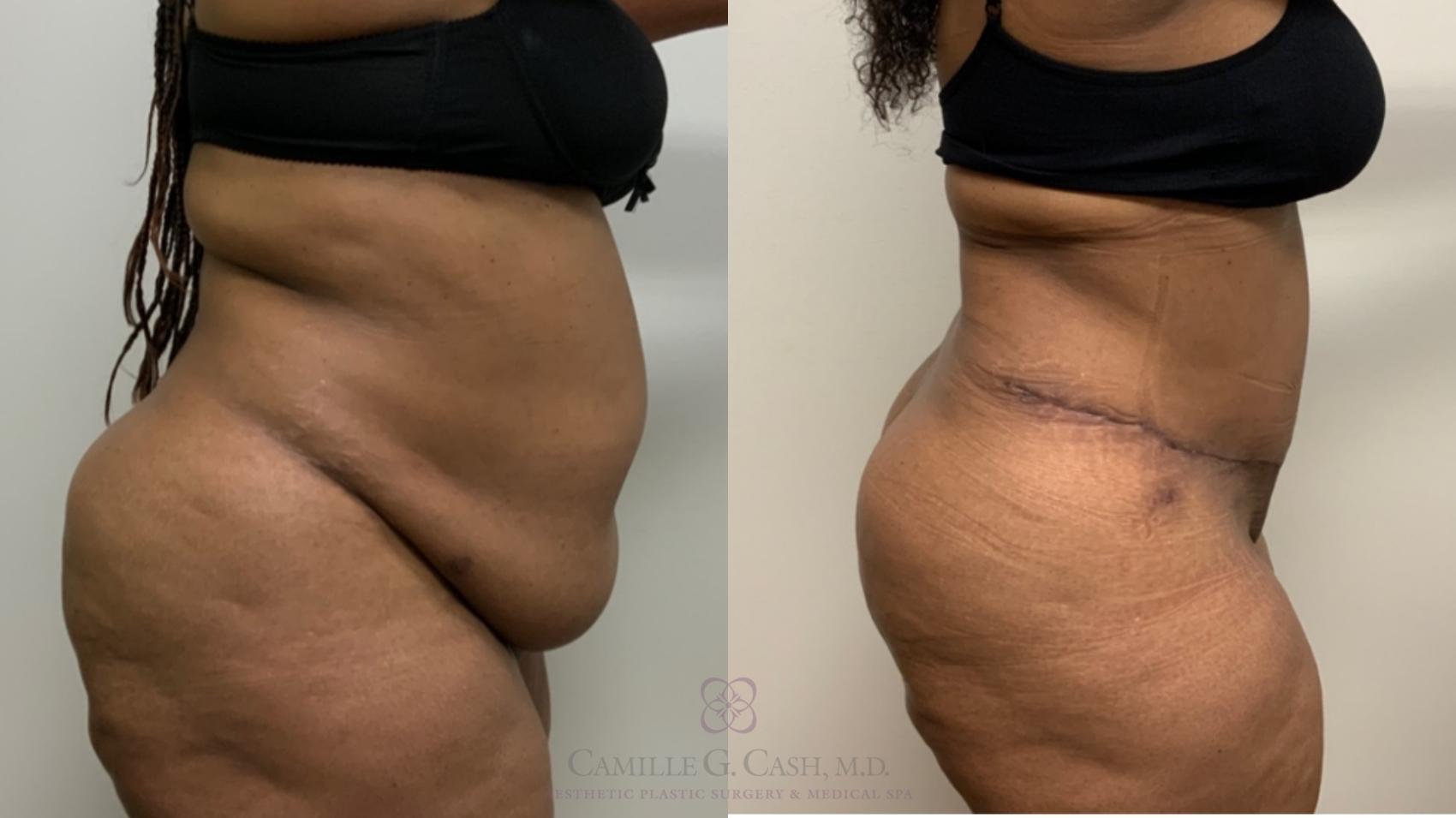 Before & After Tummy Tuck Case 518 Left Side View in Houston, TX
