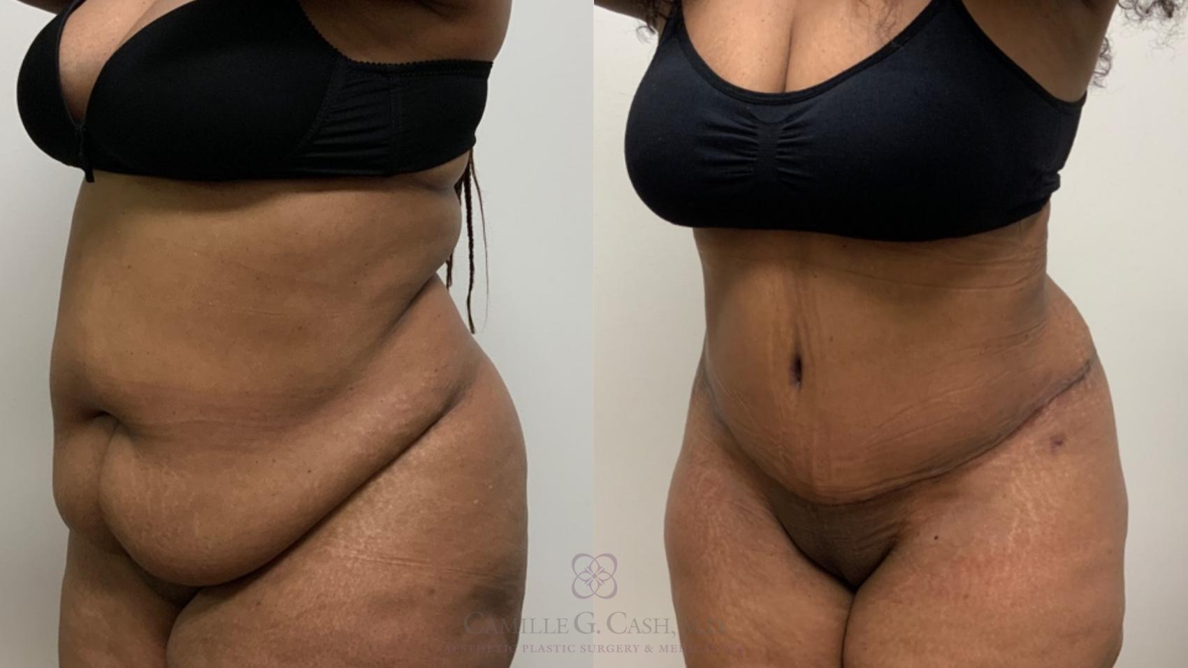 Before & After Tummy Tuck Case 518 Right Oblique View in Houston, TX