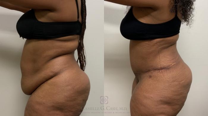 Before & After Tummy Tuck Case 518 Right Side View in Houston, TX