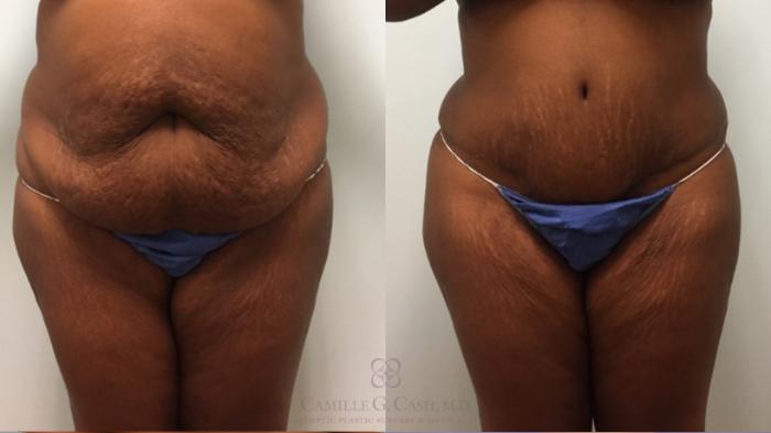 Before & After Tummy Tuck Case 529 Front View in Houston, TX