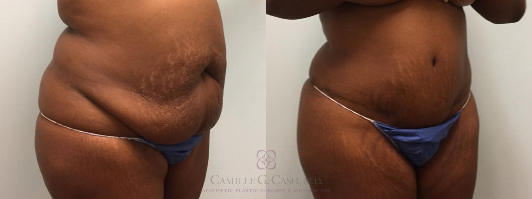 Before & After Tummy Tuck Case 529 Left Oblique View in Houston, TX