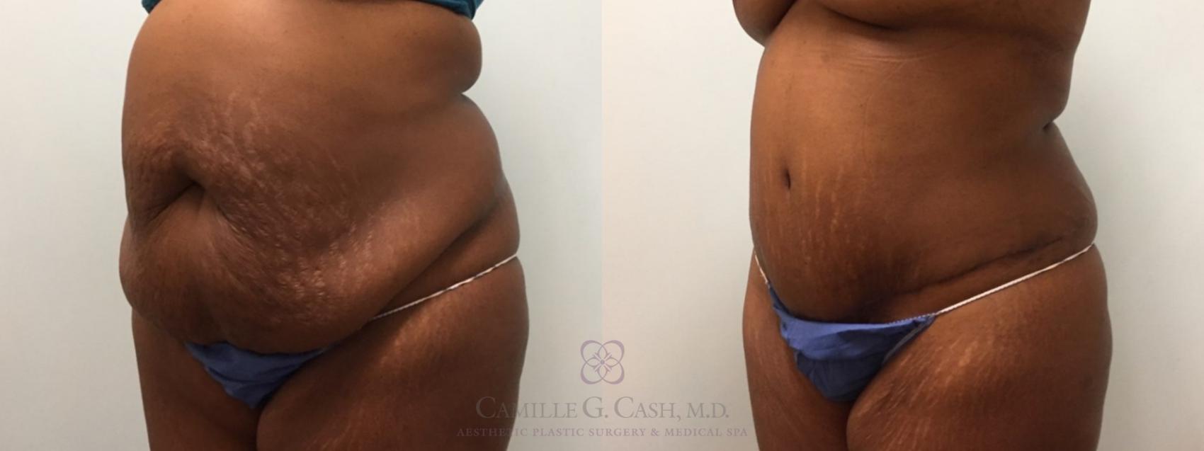 Before & After Tummy Tuck Case 529 Right Oblique View in Houston, TX