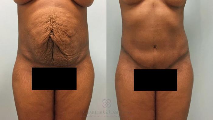 Before & After Tummy Tuck Case 535 censored thumbnail View in Houston, TX