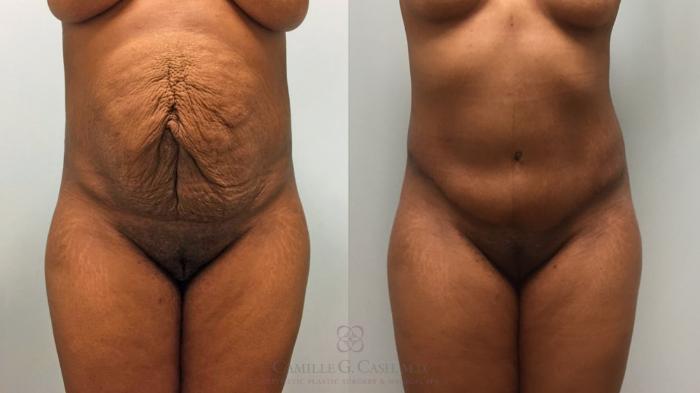 Before & After Tummy Tuck Case 535 Front View in Houston, TX