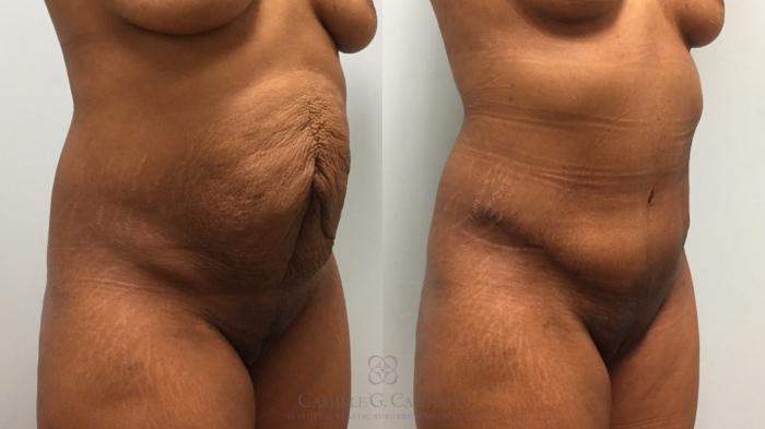 Before & After Tummy Tuck Case 535 Left Oblique View in Houston, TX