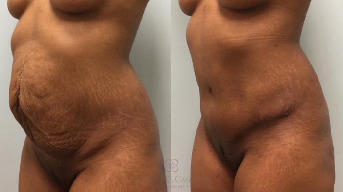Before & After Tummy Tuck Case 535 Right Oblique View in Houston, TX