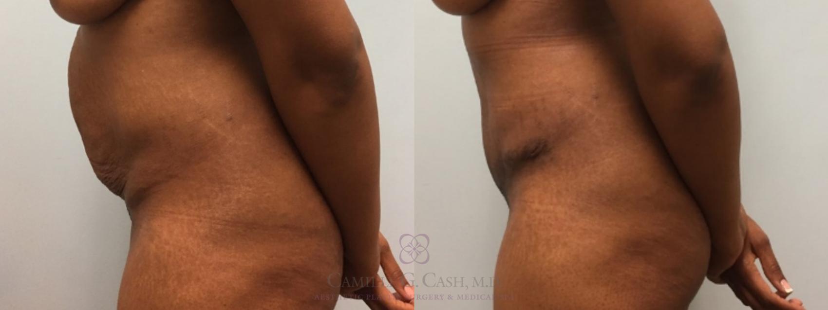 Before & After Tummy Tuck Case 535 Right Side View in Houston, TX