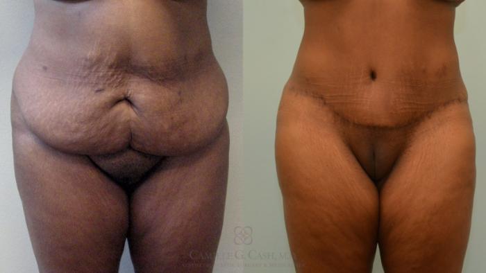 Before & After Tummy Tuck Case 536 Front View in Houston, TX