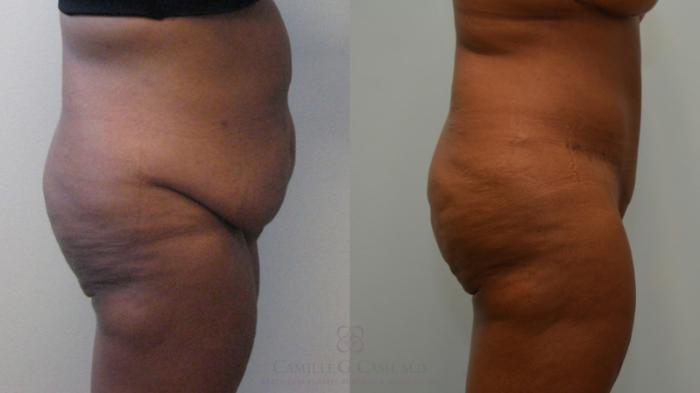 Before & After Tummy Tuck Case 536 Left Side View in Houston, TX