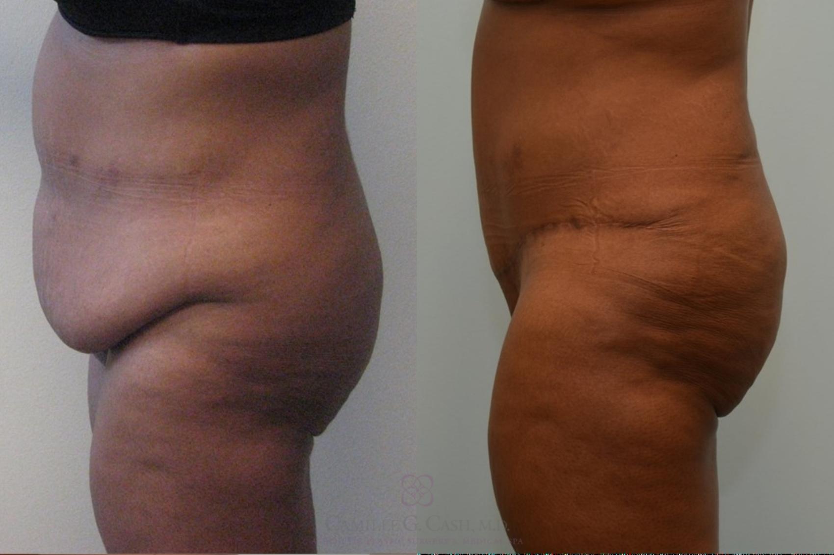 Before & After Tummy Tuck Case 536 Right Side View in Houston, TX