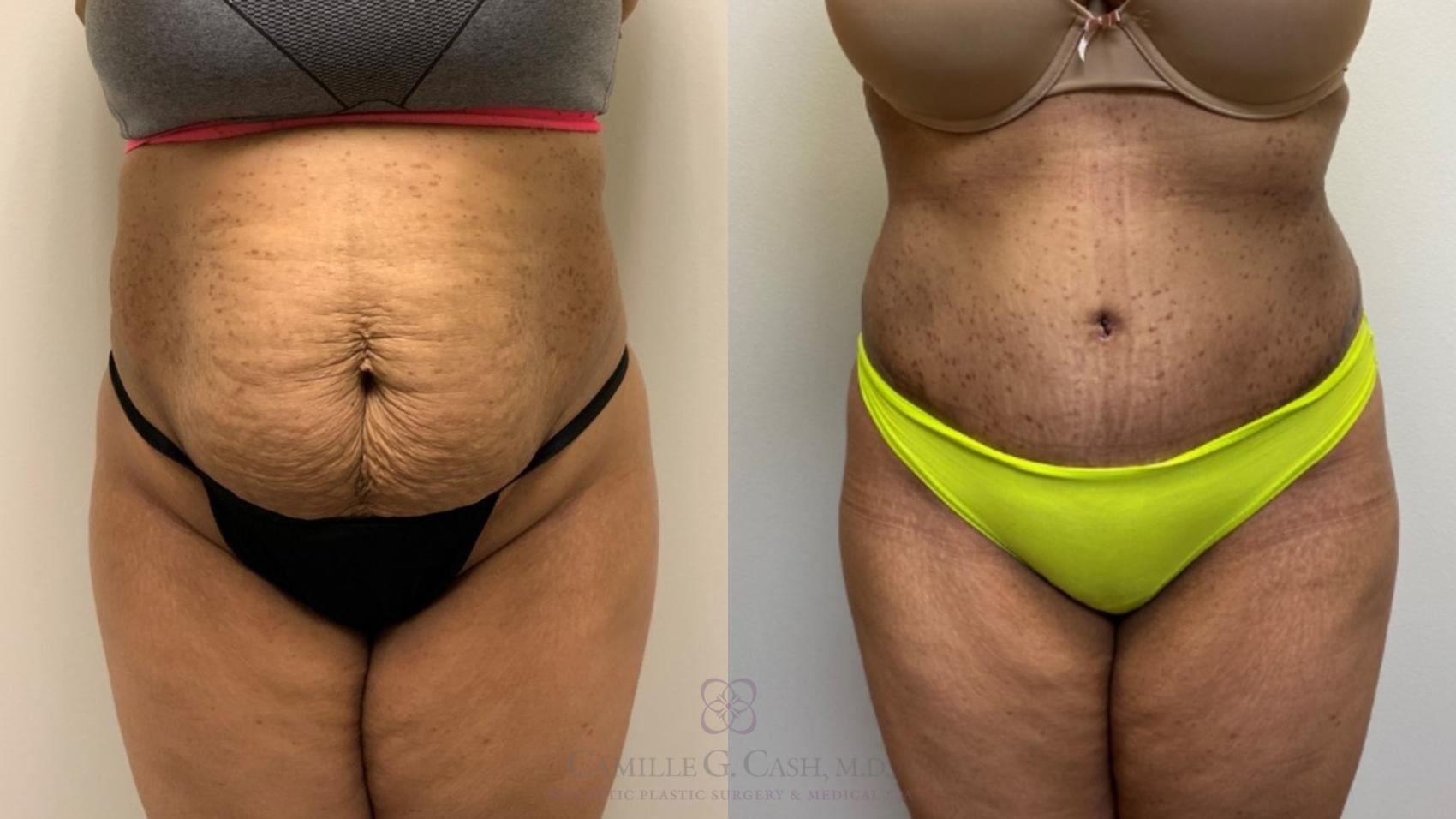 Before & After Tummy Tuck Case 539 Front View in Houston, TX