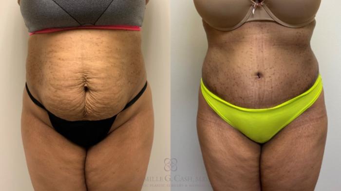 Before & After Tummy Tuck Case 539 Front View in Houston, TX