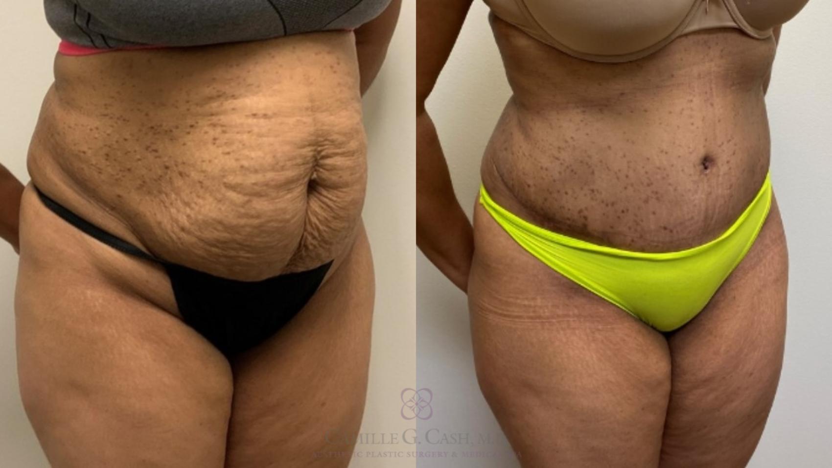 Before & After Tummy Tuck Case 539 Left Oblique View in Houston, TX