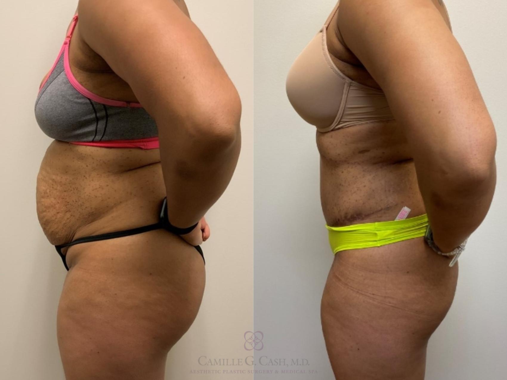 Before & After Tummy Tuck Case 539 Right Side View in Houston, TX