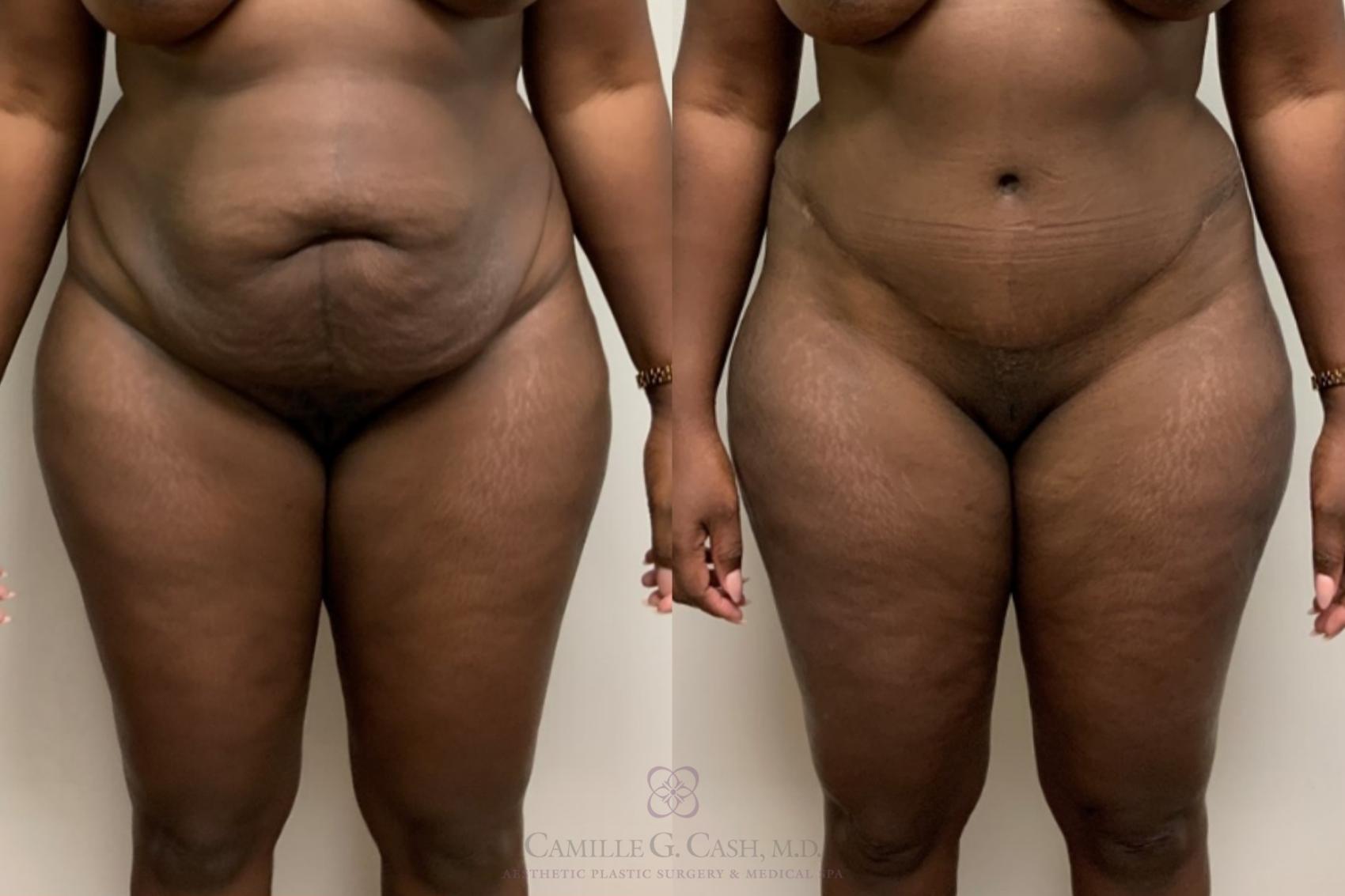Before & After Tummy Tuck Case 540 front 2 View in Houston, TX
