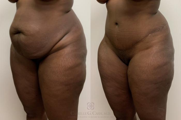 Before & After Tummy Tuck Case 540 Left Oblique View in Houston, TX