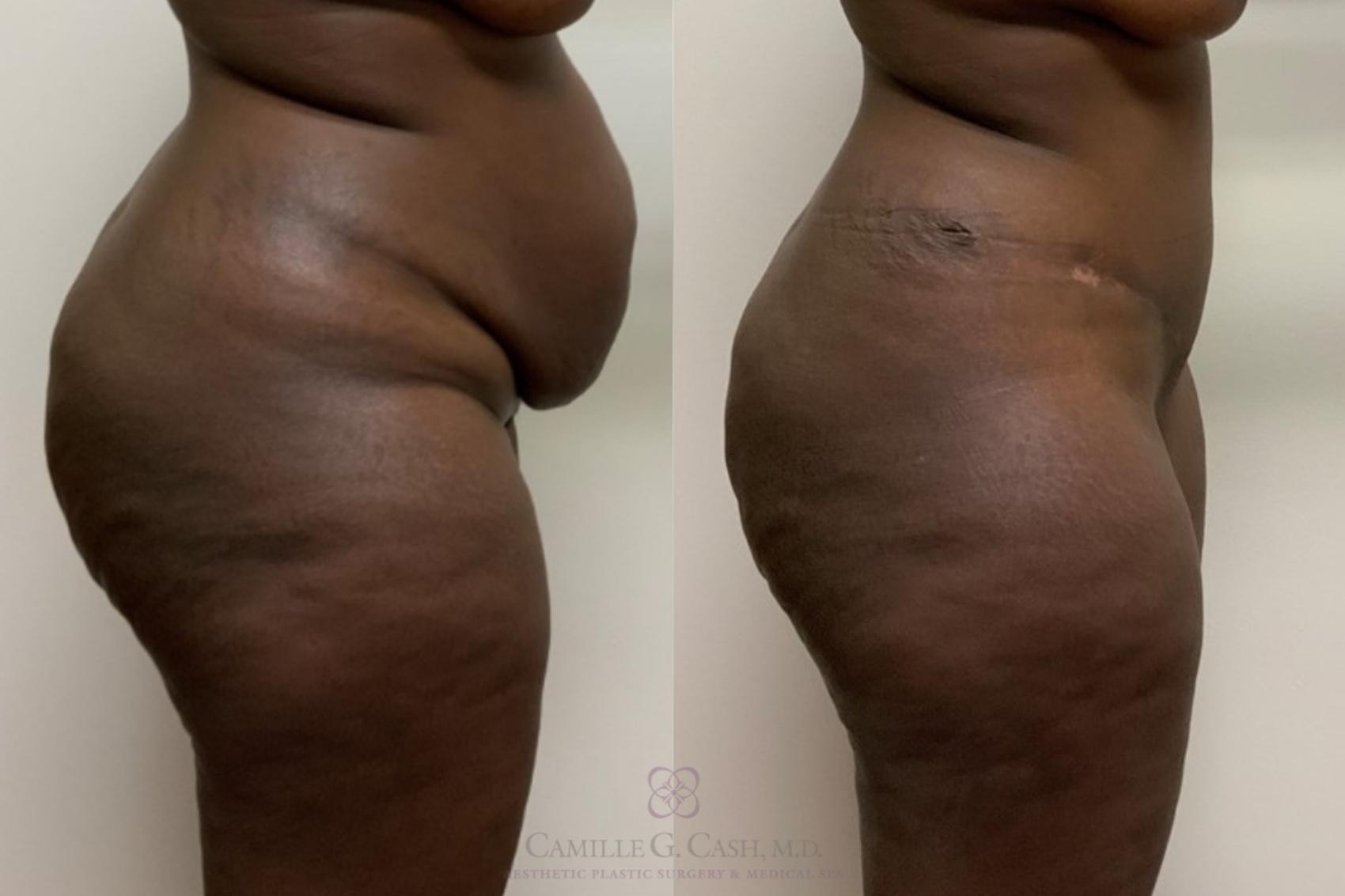 Before & After Tummy Tuck Case 540 Left Side View in Houston, TX