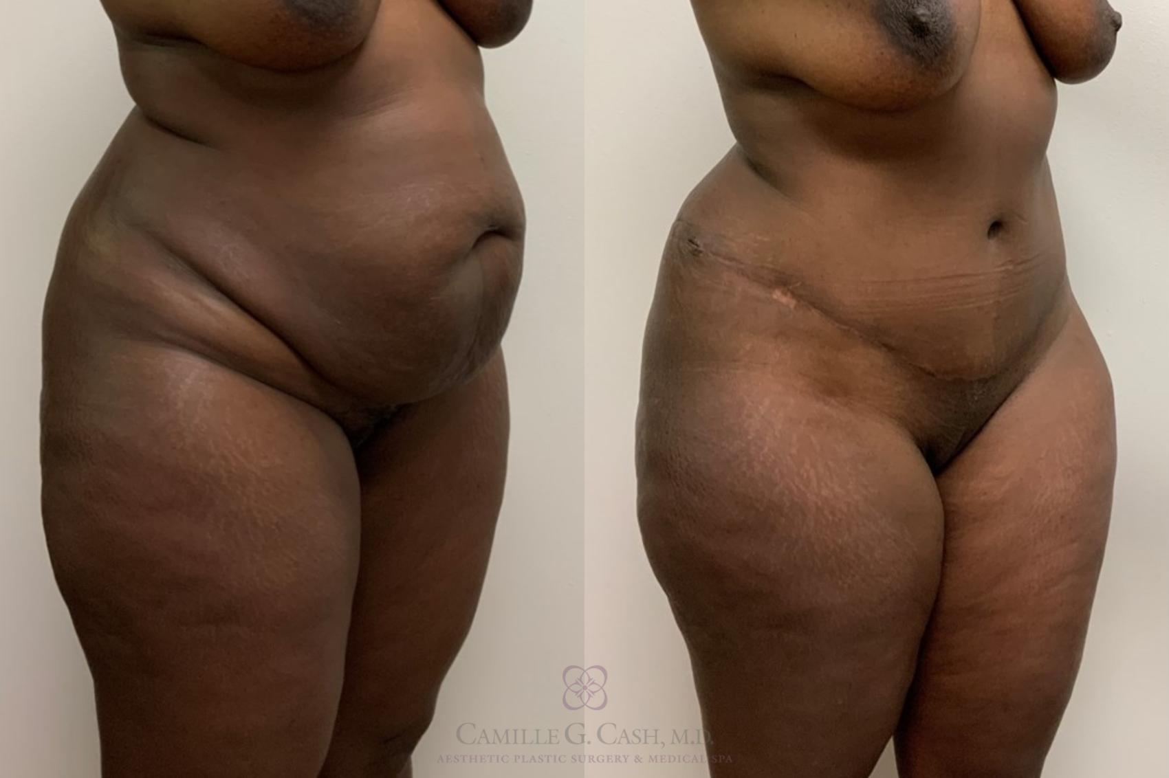 Before & After Tummy Tuck Case 540 Right Oblique View in Houston, TX