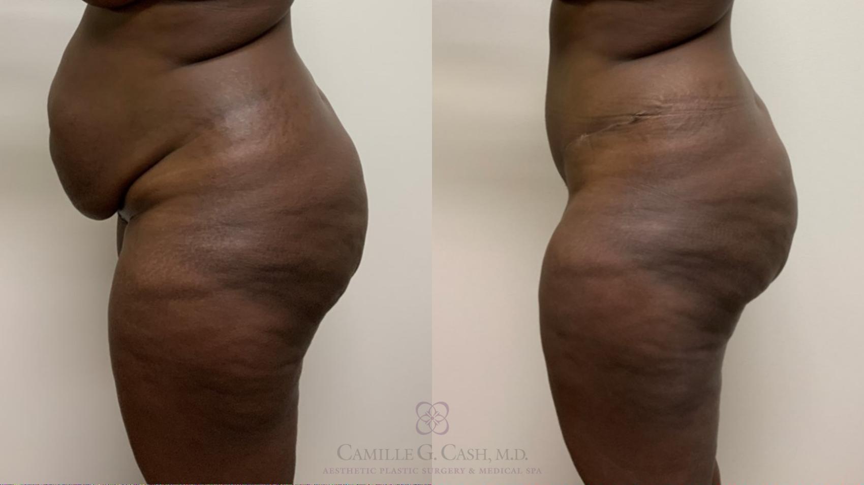 Before & After Tummy Tuck Case 540 Right Side View in Houston, TX