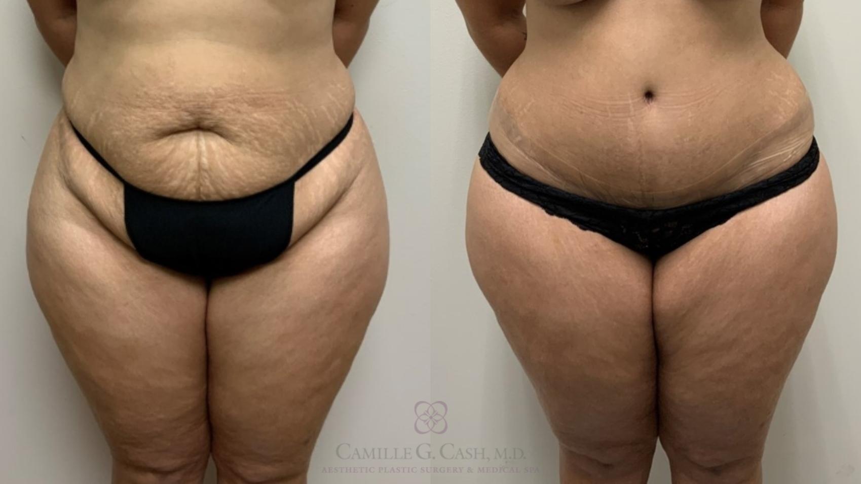 Before & After Tummy Tuck Case 557 Front View in Houston, TX