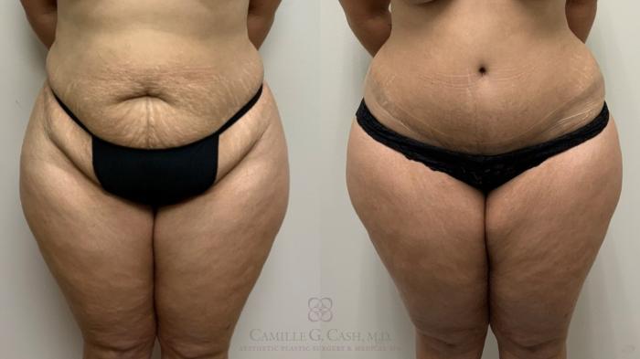 Before & After Tummy Tuck With Hernia Repair Case 557 Front View in Houston, TX