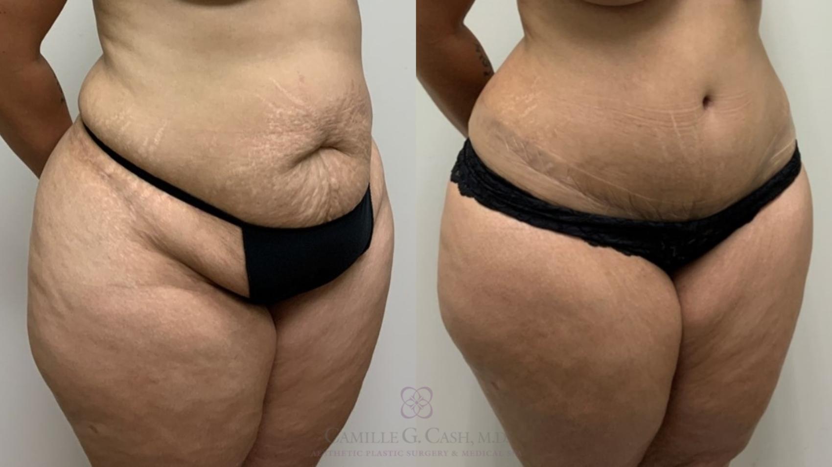Before & After Tummy Tuck Case 557 Left Oblique View in Houston, TX