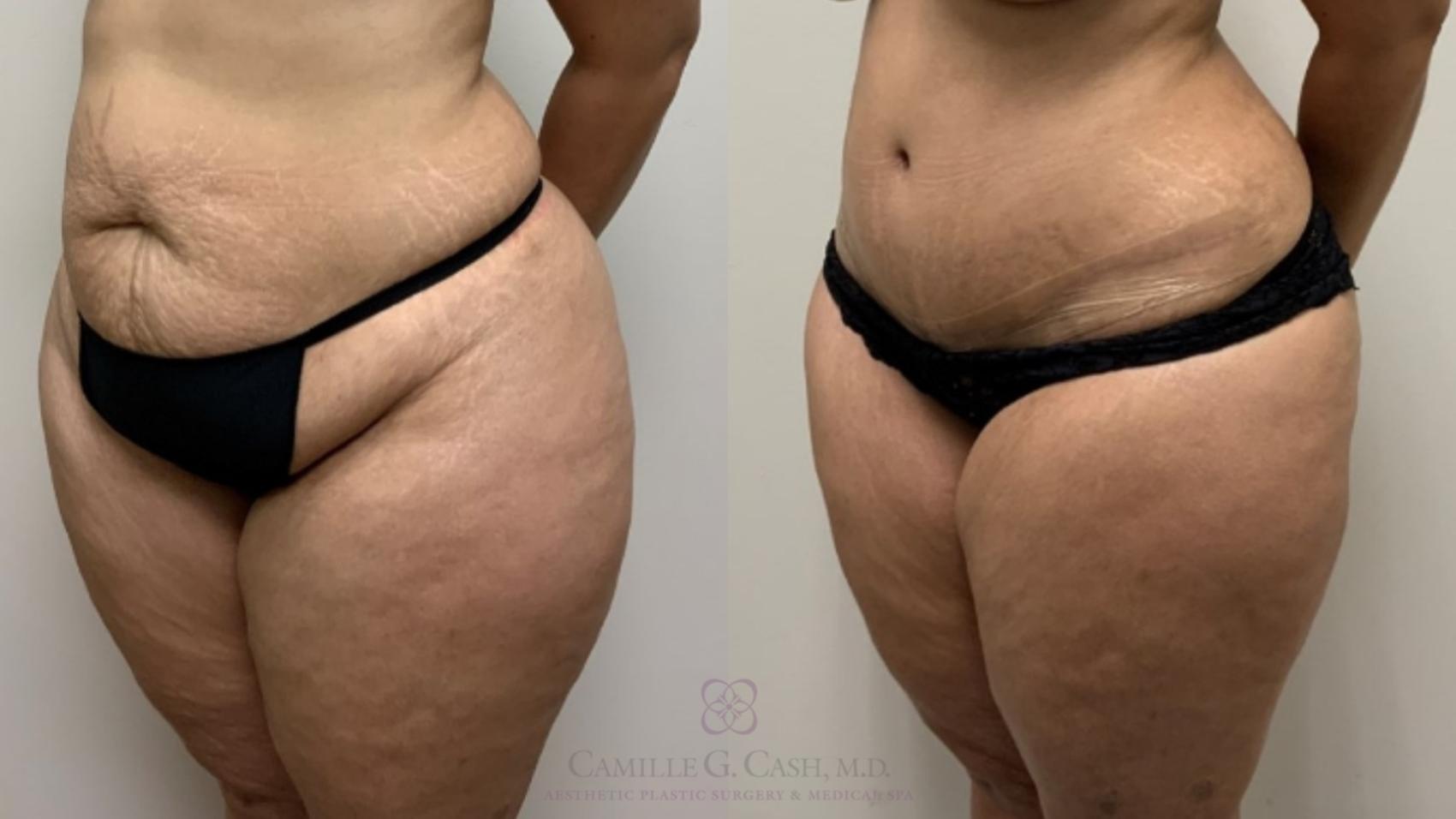 Before & After Tummy Tuck Case 557 Right Oblique View in Houston, TX