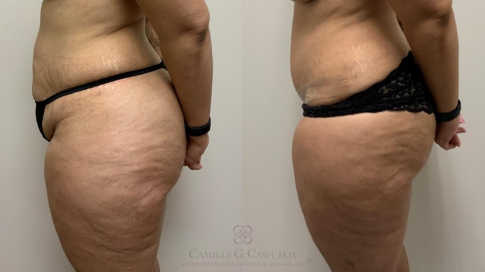 Before & After Tummy Tuck Case 557 Right Side View in Houston, TX
