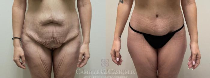 Before & After Tummy Tuck Case 558 front 2 View in Houston, TX