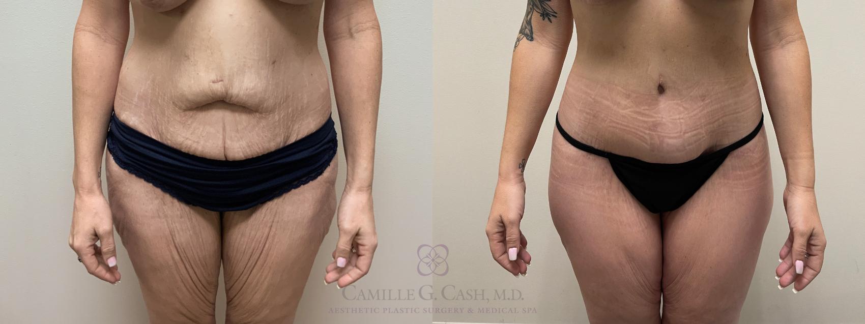 Before & After Tummy Tuck Case 558 Front View in Houston, TX