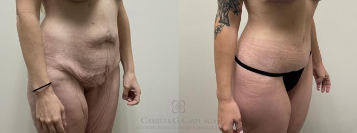 Before & After Tummy Tuck Case 558 Left Oblique View in Houston, TX