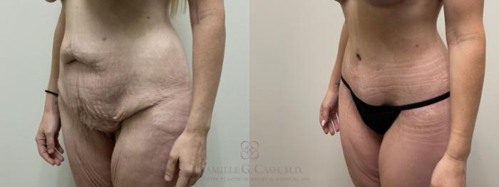 Before & After Tummy Tuck Case 558 Right Oblique View in Houston, TX