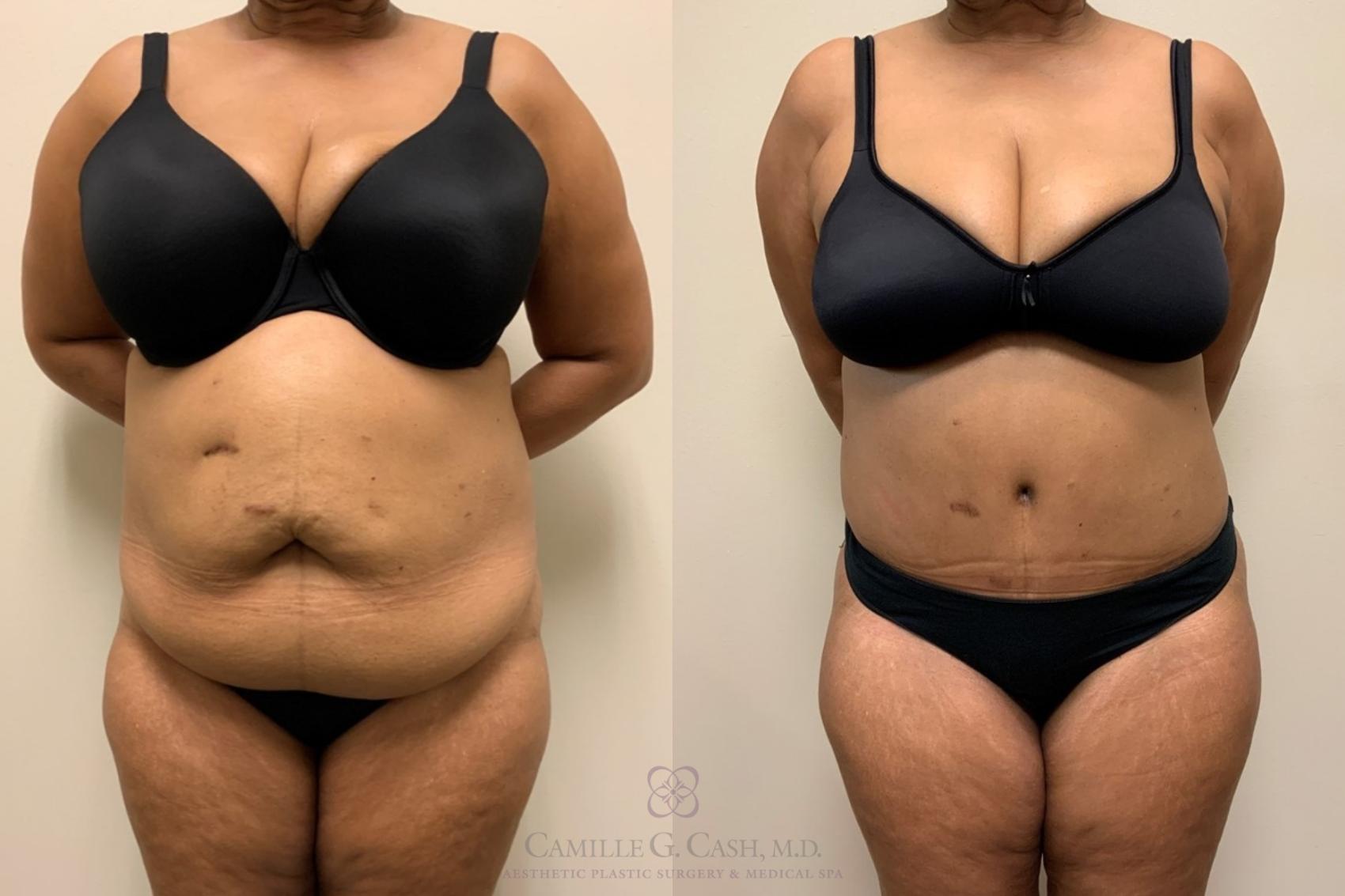 Before & After Tummy Tuck Case 560 Front View in Houston, TX